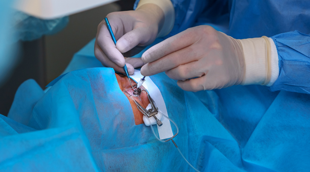 Proceso de cirugia